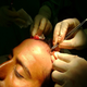 Illustration for article titled Hair Transplant in Rawalpindi/Islamabad